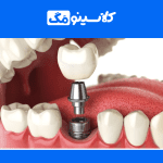 معرفی رشتۀ ساخت پروتزهای دندانی، گرایش، بازار کار، توانایی‌ها